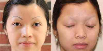Удаление перманентного макияжа с глаз
