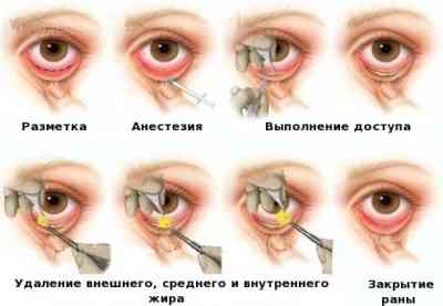 Макияж для глаз после блефаропластики